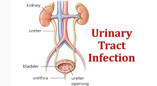 UTI বা প্রস্রাবে জ্বালাপোড়ার কারণ, লক্ষণ, চিকিৎসা