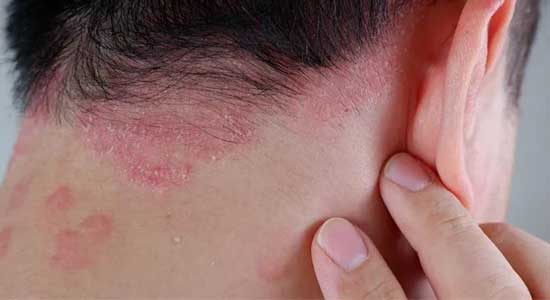 সোরিয়াসিস নিয়ে নানা প্রশ্ন