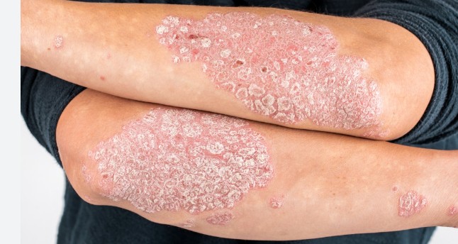 সোরিয়াসিসের (Psoriasis) কারণ, প্রকারভেদ, হোমিও চিকিৎসা