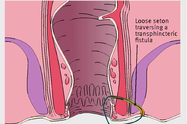 অ্যানাল ফিস্টুলা কেন হয়, সঠিক চিকিৎসা কী?