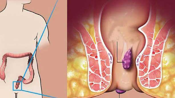 ফিস্টুলায় কে বেশি আক্রান্ত হন, নারী নাকি পুরুষ?