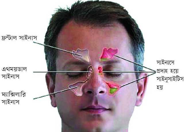 সাইনোসাইটিস যেভাবে হয়, কারণ ও রোগ নির্ণয়