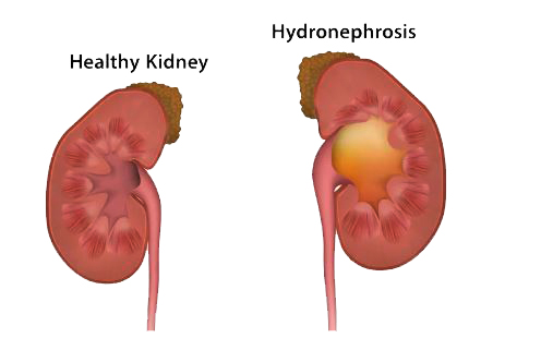হাইড্রোনফ্রোসিস বা কিডনি ফুলে যাওয়ার কারণ, লক্ষণ ও চিকিৎসা