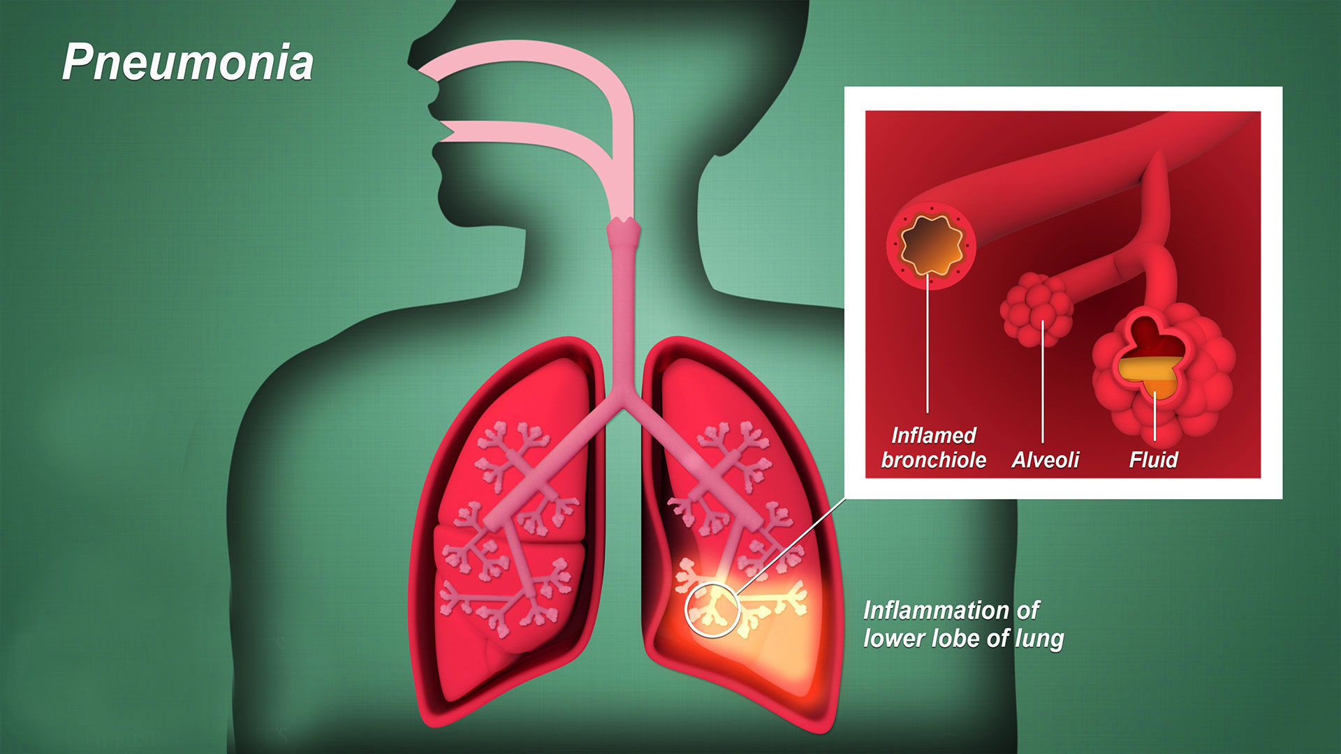 নিউমোনিয়ার কারণ-লক্ষণ প্রকার ও হোমিওপ্যাথিক চিকিৎসা