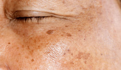 ত্বকে ‌‘লিভার স্পট’ বা ‘এজ স্পট’: কারণ ও প্রতিকার