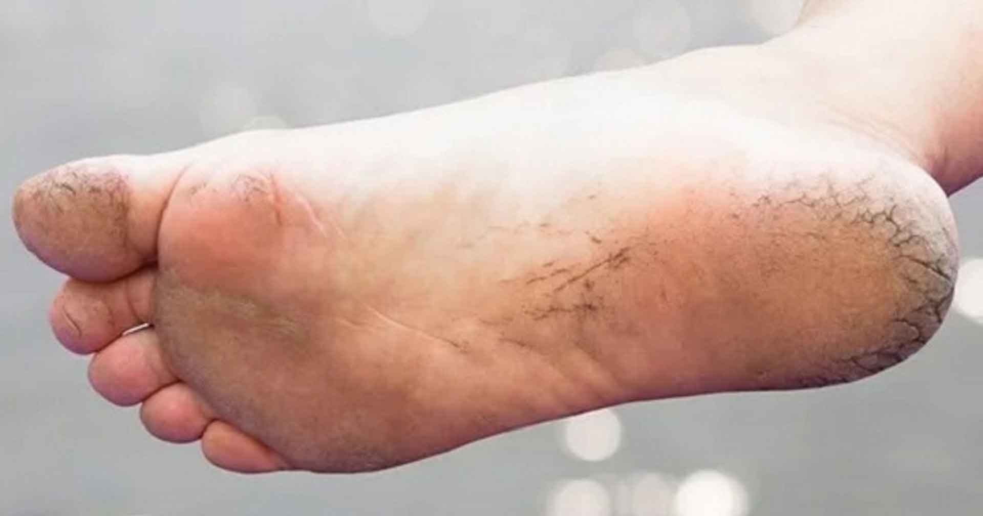 পা ফাটার নেপথ্যে থাকতে পারে যে ৪ রোগ