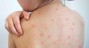 হাম কী, কারা আক্রান্ত হয়?