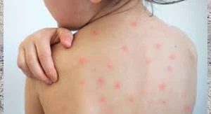 হাম কীভাবে ছড়ায়?