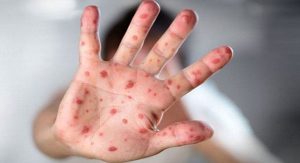 হামের লক্ষণ ও উপসর্গ কী কী?